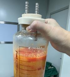 大理水动力吸脂手术要做多久？